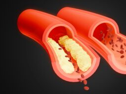 Vascular Disorders
