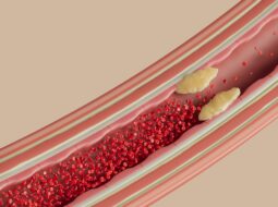 Carotid artery stenosis