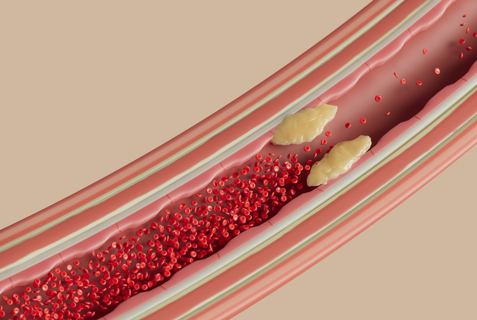 Carotid artery stenosis